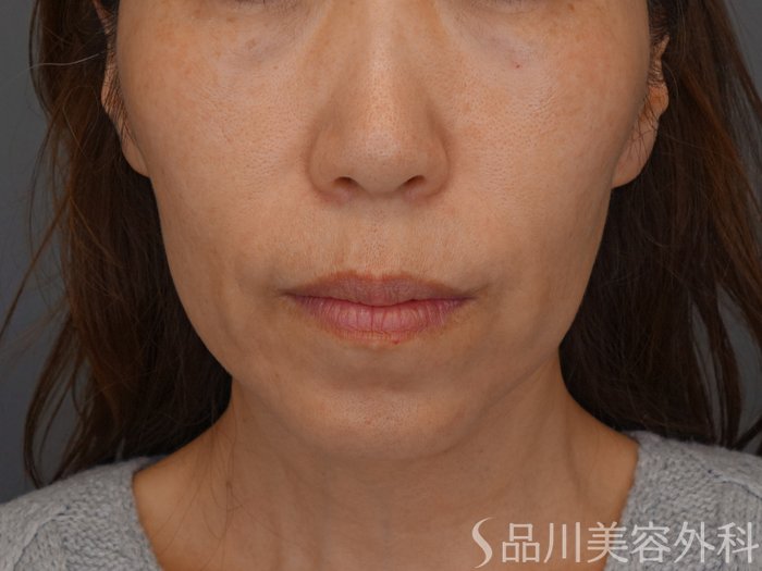 症例NO.74295のBEFORE写真
