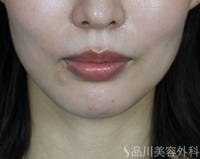 症例NO.70119のBEFORE写真