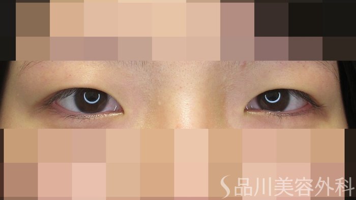 症例NO.71481のBEFORE写真