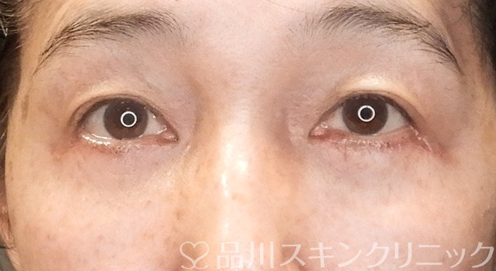 症例NO.63445のAFTER写真