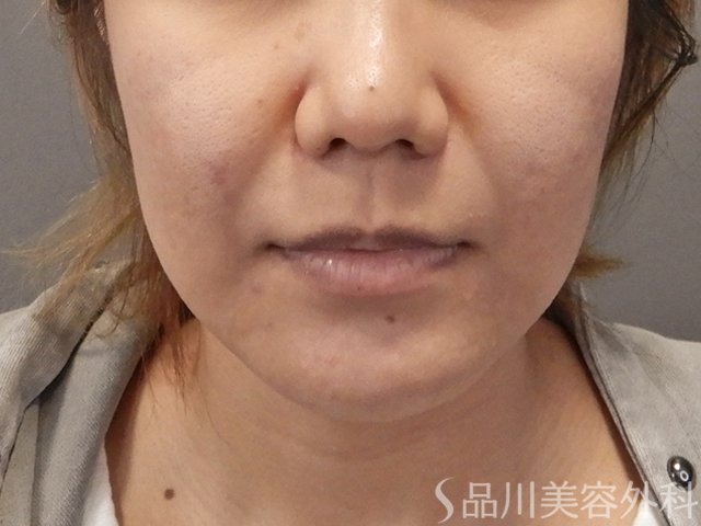 症例NO.74604のBEFORE写真