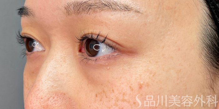 症例NO.73568のBEFORE写真