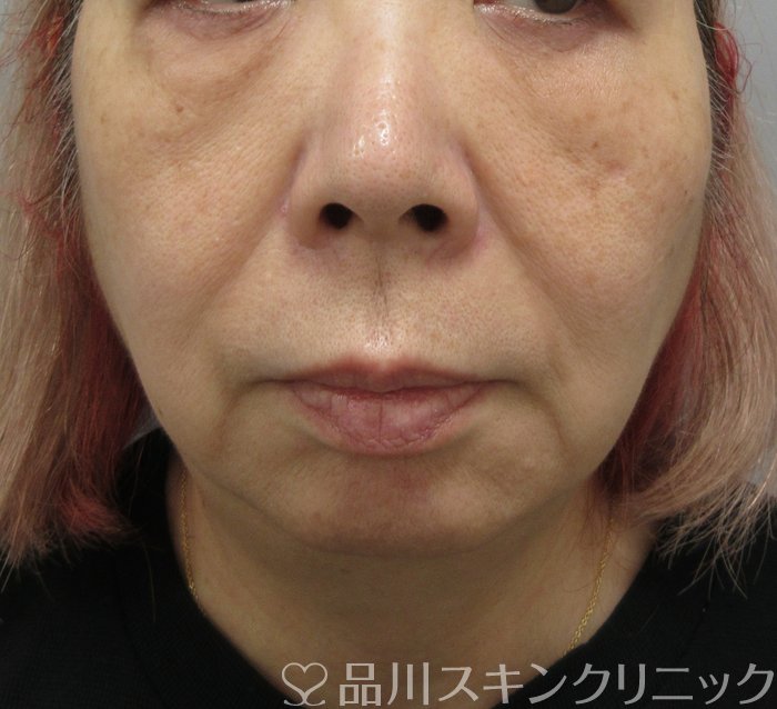 症例NO.73152のBEFORE写真