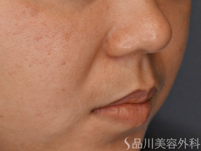 症例NO.70994のBEFORE写真