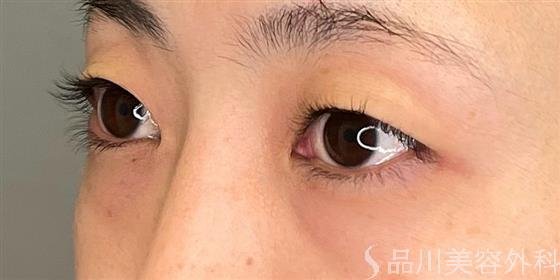 症例NO.50482のBEFORE写真