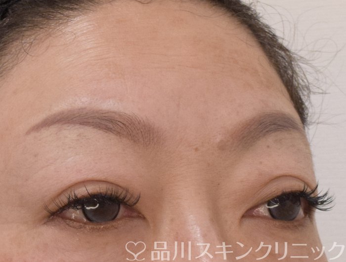 症例NO.75255のAFTER写真