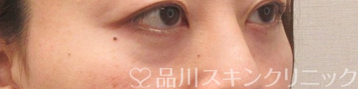 症例NO.71270のBEFORE写真