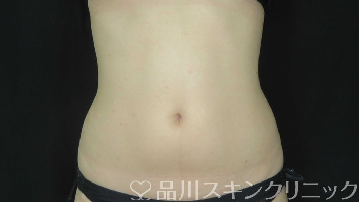 症例NO.72097のAFTER写真