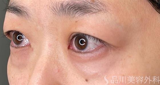 症例NO.50740のBEFORE写真