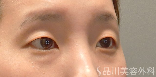 症例NO.73194のBEFORE写真