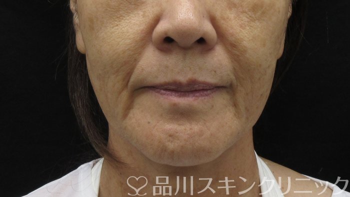 症例NO.71372のBEFORE写真