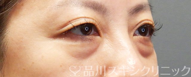 症例NO.72694のBEFORE写真