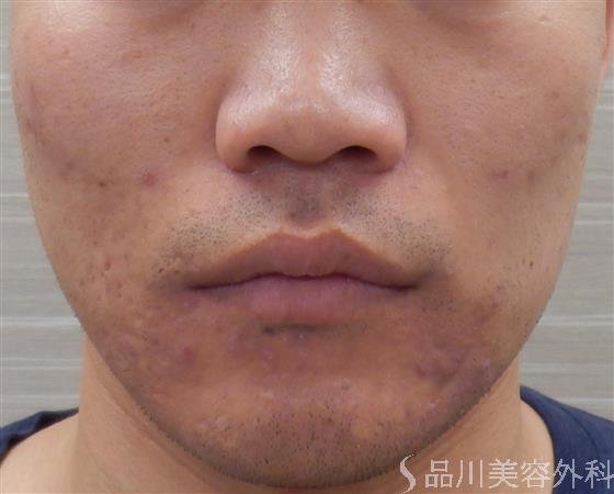 症例NO.36337のAFTER写真