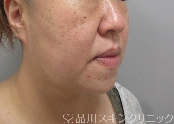 症例NO.71463のBEFORE写真