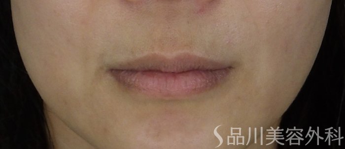 症例NO.69874のBEFORE写真