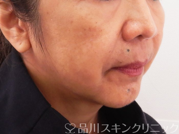 症例NO.62186のBEFORE写真