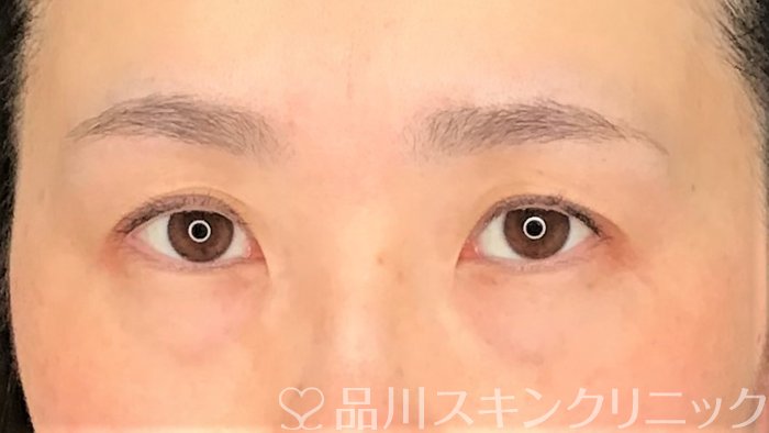 症例NO.62267のBEFORE写真