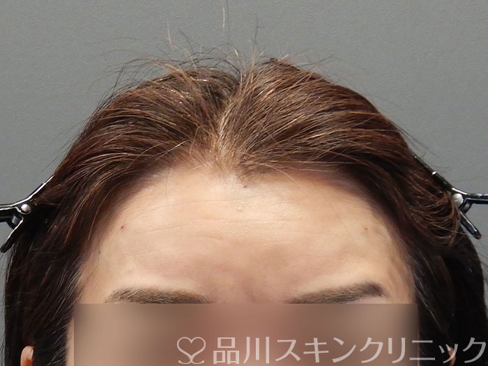 症例NO.72652のAFTER写真