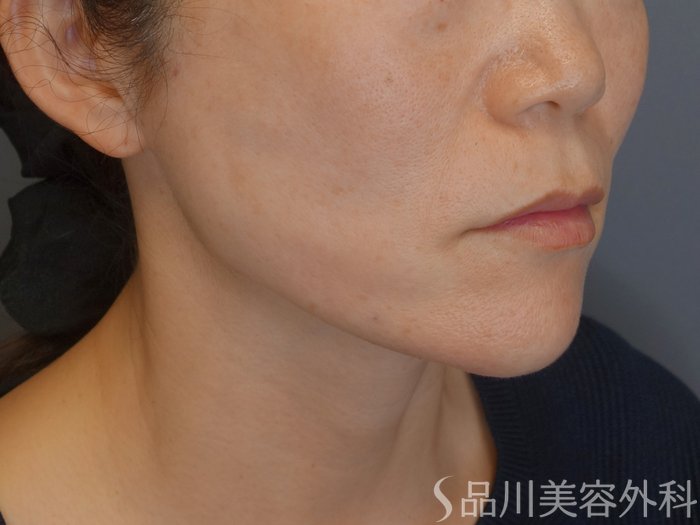 症例NO.72196のAFTER写真