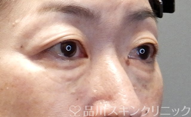 症例NO.65034のAFTER写真