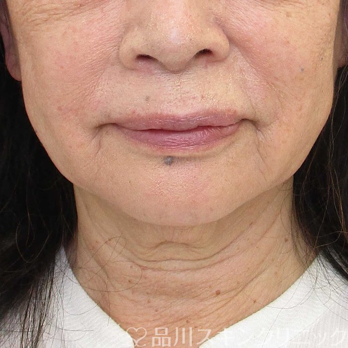 症例NO.65549のBEFORE写真