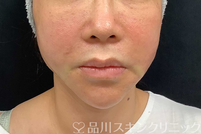 症例NO.69917のAFTER写真