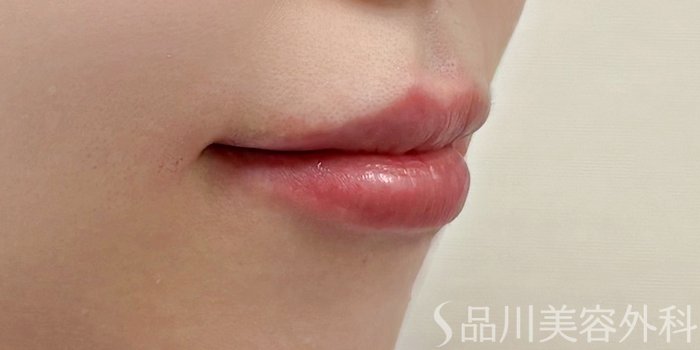 症例NO.70190のAFTER写真