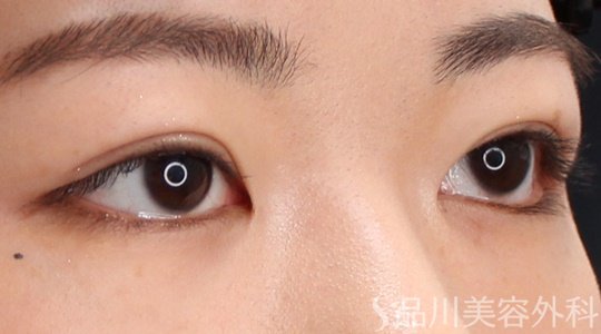 症例NO.69676のAFTER写真