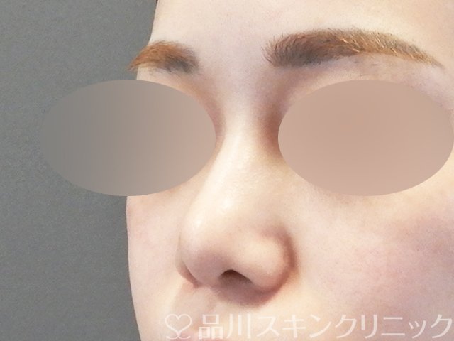 症例NO.66919のBEFORE写真