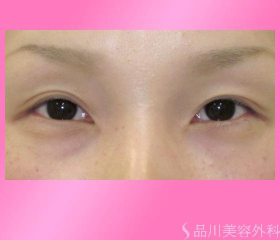 症例NO.2030のBEFORE写真