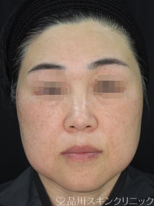 症例NO.72851のAFTER写真