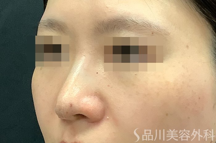 症例NO.71249のAFTER写真