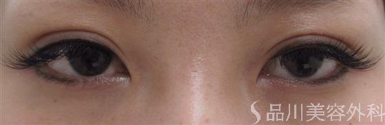 症例NO.20058のAFTER写真