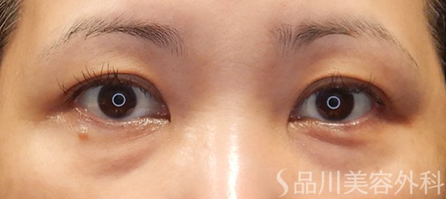 症例NO.71713のBEFORE写真
