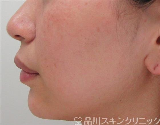 症例NO.31860のAFTER写真