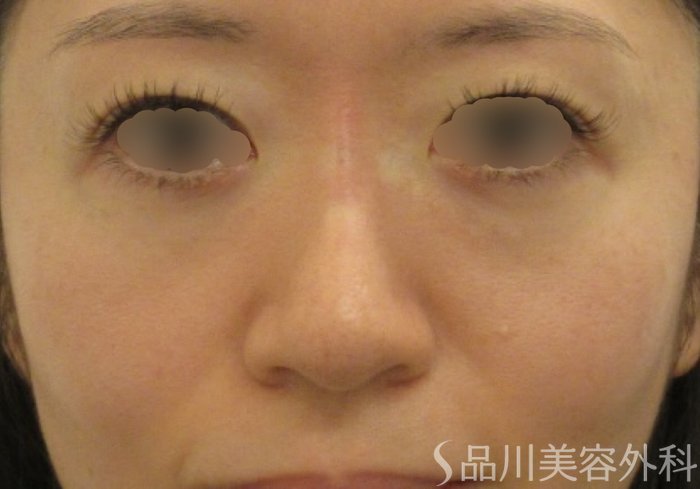 症例NO.72267のAFTER写真