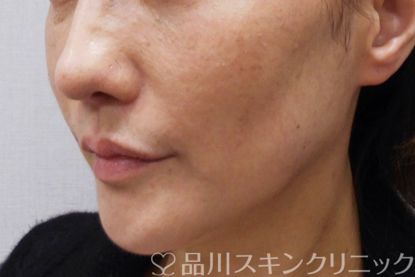 症例NO.69671のBEFORE写真