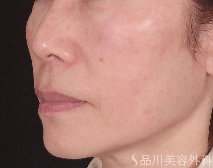 症例NO.70263のBEFORE写真