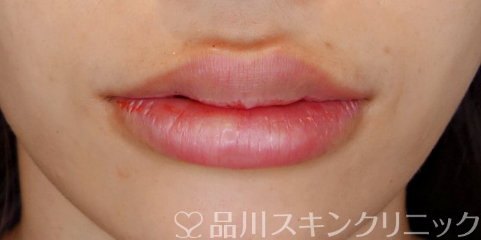症例NO.70899のAFTER写真
