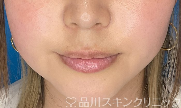 症例NO.74794のAFTER写真