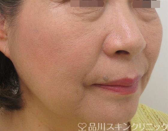 症例NO.26429のBEFORE写真