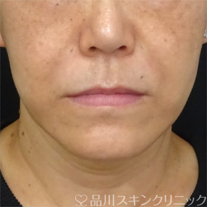 症例NO.69323のAFTER写真