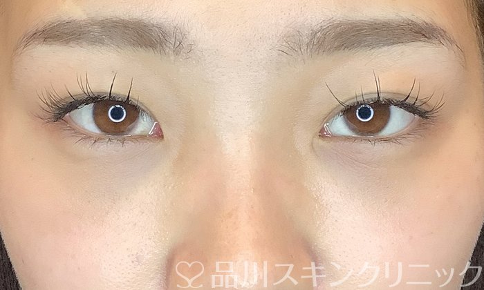 症例NO.70386のAFTER写真