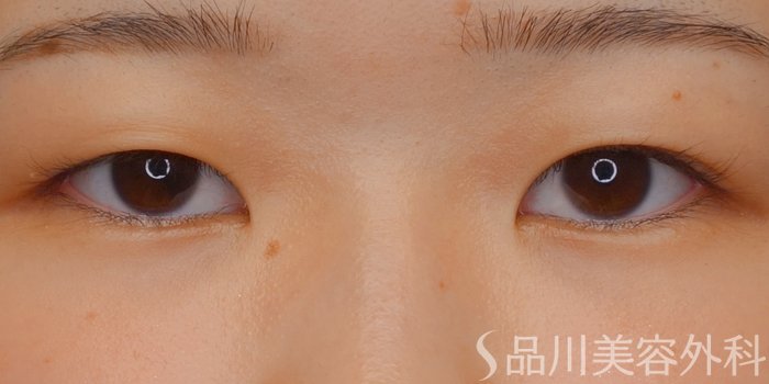 症例NO.72344のBEFORE写真