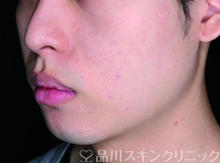 症例NO.67627のAFTER写真
