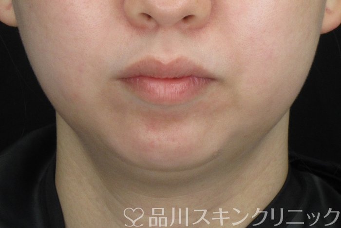 症例NO.64366のBEFORE写真