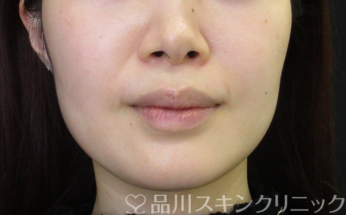 症例NO.65571のBEFORE写真