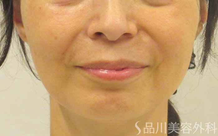 症例NO.71726のAFTER写真