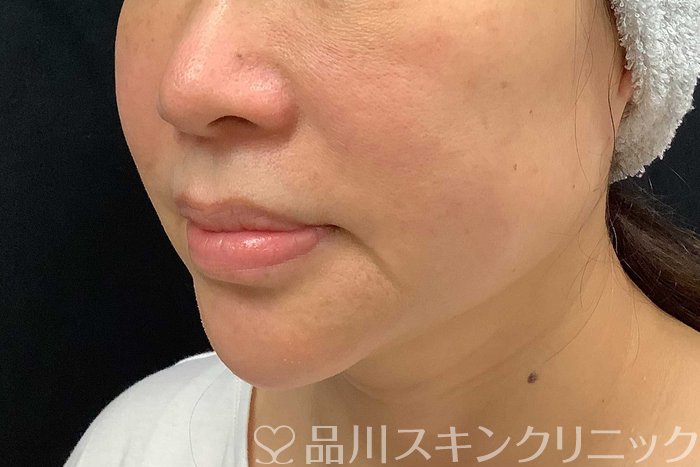 症例NO.69917のBEFORE写真