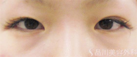 症例NO.27514のBEFORE写真